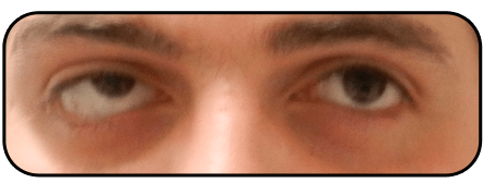 ניתוח פזילה - לפני