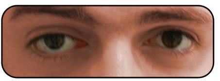 ניתוח פזילה - אחרי